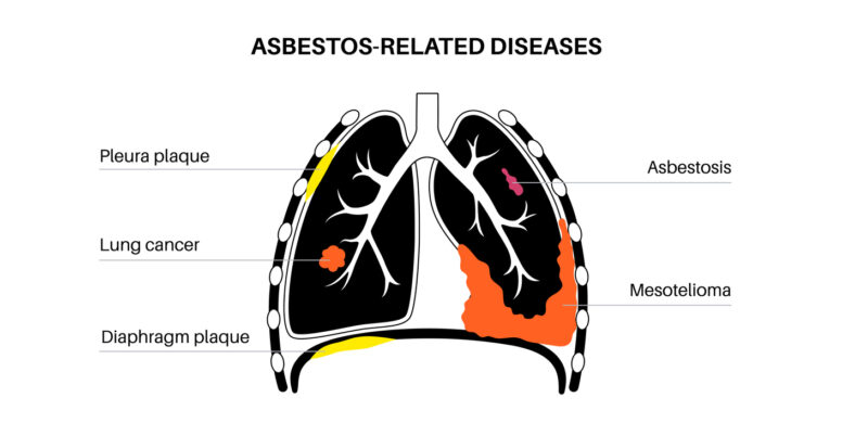 asbestos diseases